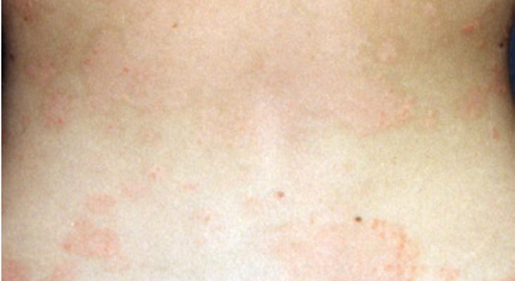 Cure thermale psoriasis | Avene Center