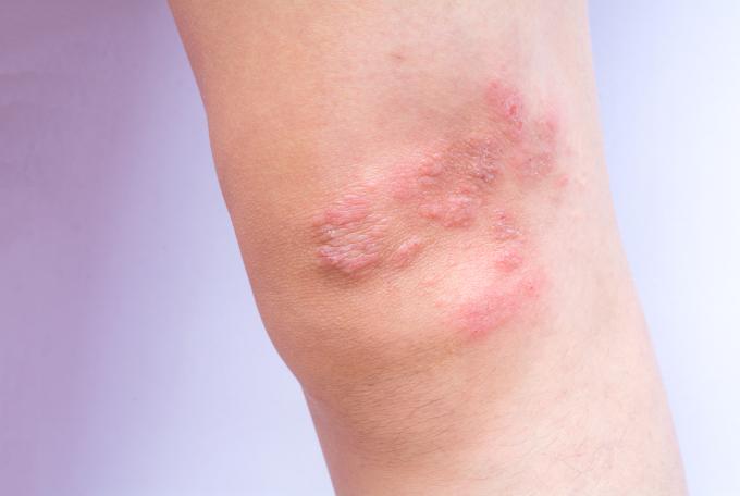 marque d'eczéma sur le genoux