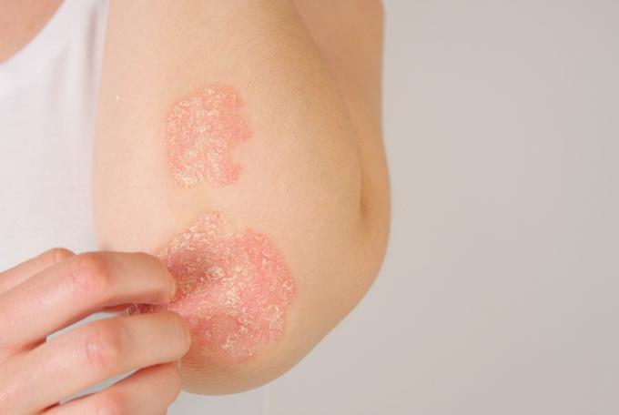 avant bras atteint de psoriasis