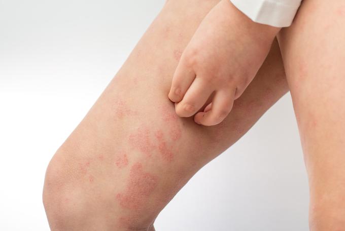 Eczema et dermatite atopique, causes et traitements