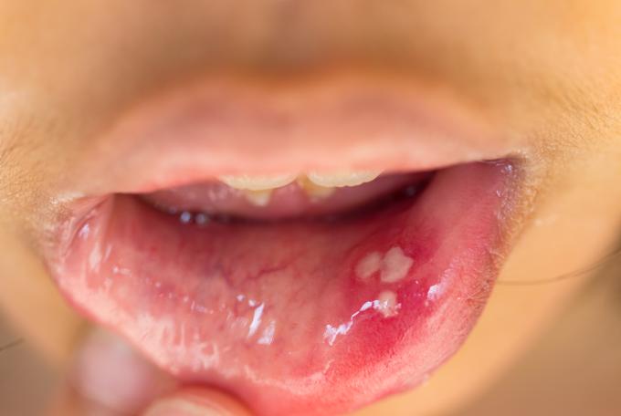personne ayant un lichen sur la lèvre inférieur de la bouche
