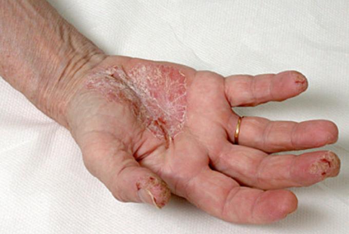 Eczéma des Mains : Causes, Symptômes & Traitement