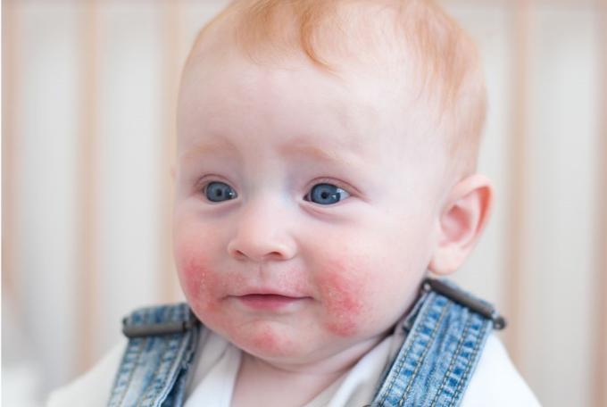 Bébé avec de l'eczéma sur le visage