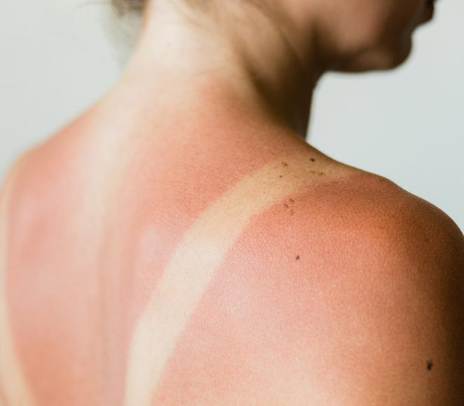 femme ayant un coup de soleil au dos