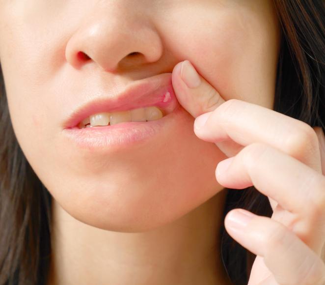 femme ayant un lichen sur la lèvre supérieur de la bouche