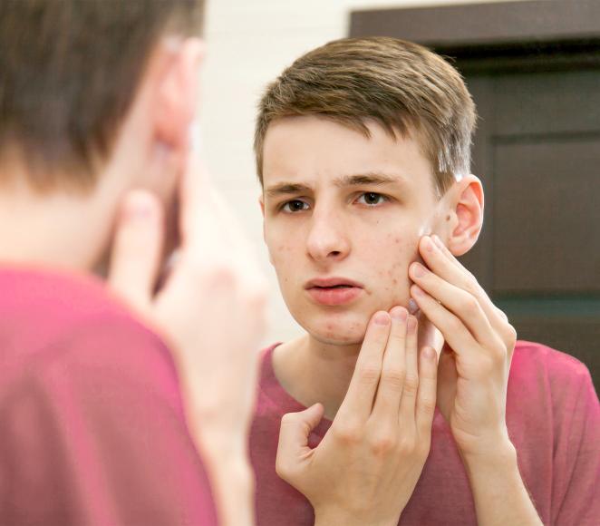 visage d'un jeune homme avec de l'acné