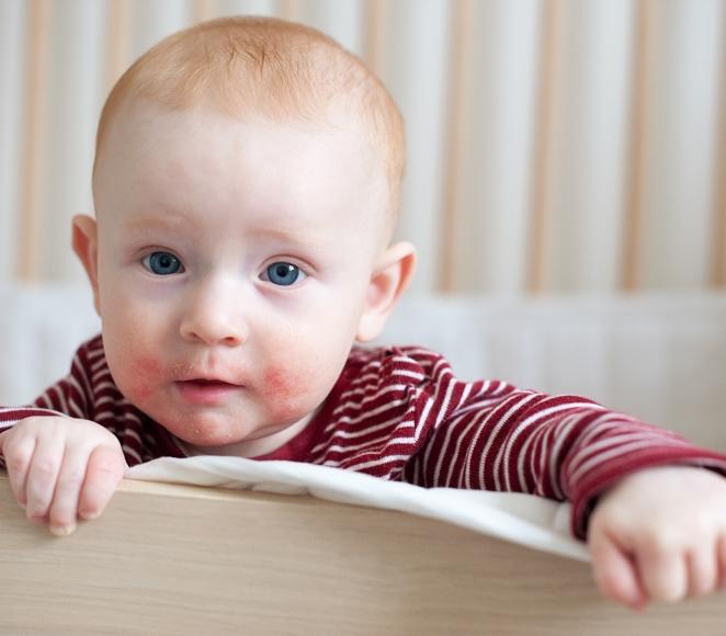 Thermal hydrotherapy for infantile eczema Avene Center