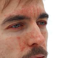 homme atteint de psoriasis sur le visage