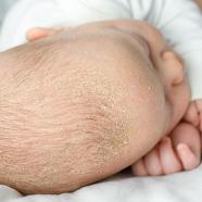 crane de bébé atteint de dermite séborrhéique