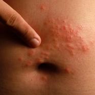 nombril atteint de psoriasis inversé