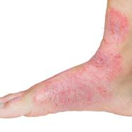 Psoriasis, causes, symptômes et traitements