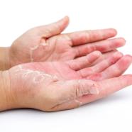 main atteinte de psoriasis palmoplantaire
