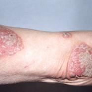 bras atteint de psoriasis en plaque