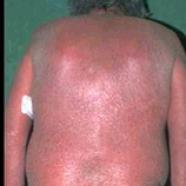 corps atteint de psoriasis érythrodermique