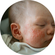 Bébé avec de l'eczéma sur la joue